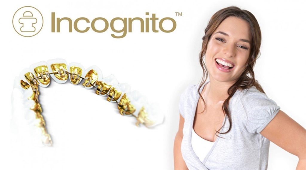 Lingual & Incognito Braces: The Completely Hidden Braces Option 2